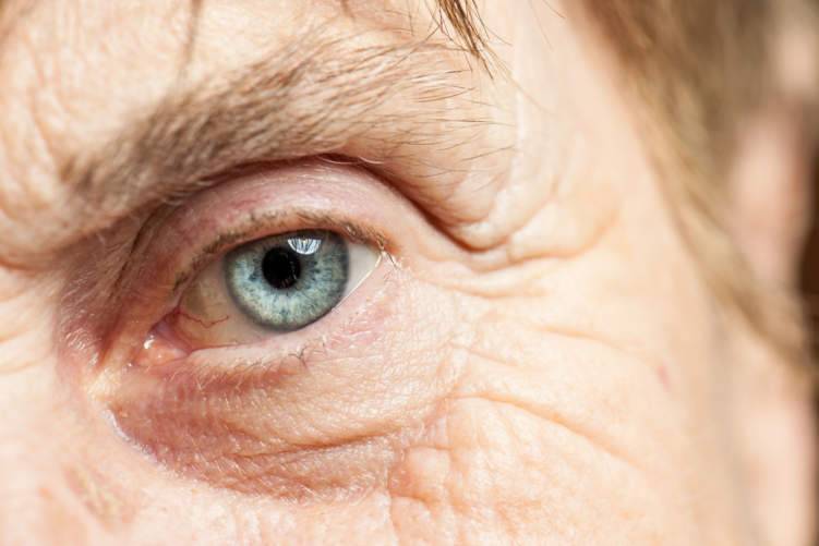 مرض إعتام عدسية العين: أسبابه وسبل العلاج