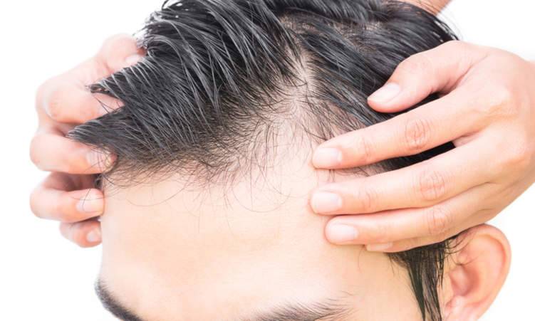 علاج تساقط الشعر بالأدوية