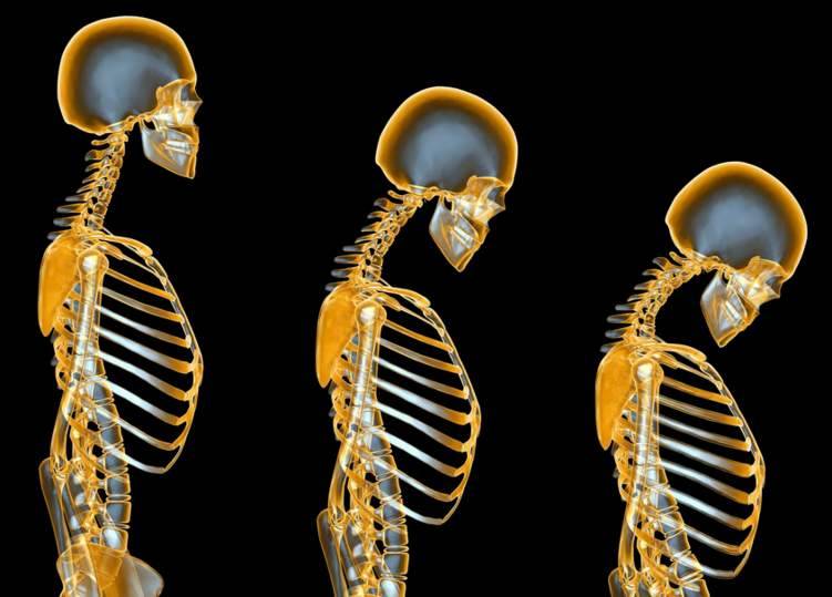 ما هو مرض هشاشة العظام وأعراضه وكيفية الوقاية منه؟