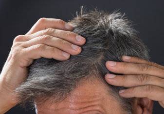 3 طرق فعالة للتخلص وعلاج قشرة الشعر نهائيا