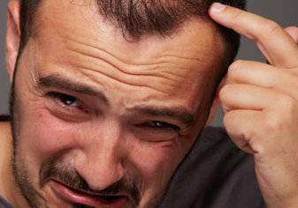 4 أسباب غير متوقعة لتساقط الشعر والاصابة بالصلع