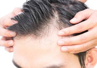 علاج تساقط الشعر بالأدوية