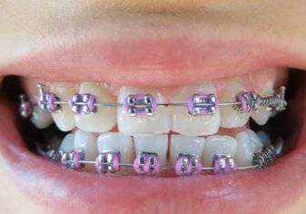 ليست للتجميل فقط.. ما هي أهمية عمليات تقويم الأسنان؟ (فيديو)