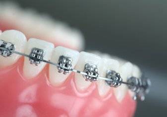 هل هناك خطورة من إهمال القيام بعملية تقويم الأسنان؟ (فيديو)