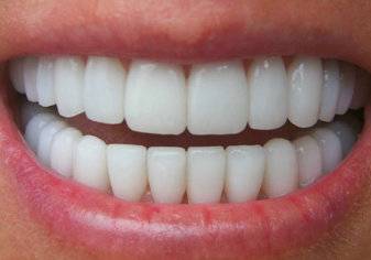 هل يمكن أن تؤدي عملية "هوليوود سمايل" للأسنان لنتائج غير مُرضية؟ (فيديو)