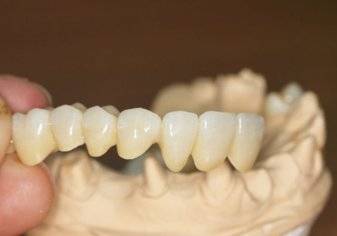 ما هي أسباب فشل عمليات تجميل الأسنان؟ (فيديو)