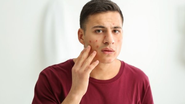 علاج حبوب الوجه الحمراء الملتهبة متنوع وشاسع