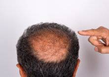 كل ما تريد أن تعرفه عن زراعة الشعر