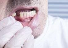 ما هي أسباب فقدان الأسنان وما هو العلاج الأمثل؟ (فيديو)